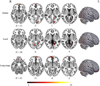 The altered functional connectivity density related to cognitive impairment in alcoholics